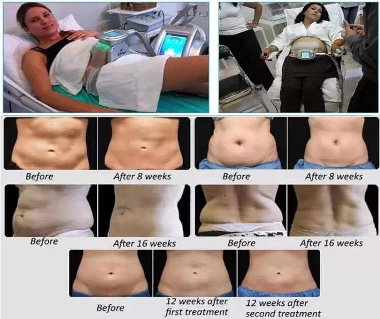 Cryo 360 Degree Machine Fat Removal with Large Small Mini Cryo Handles