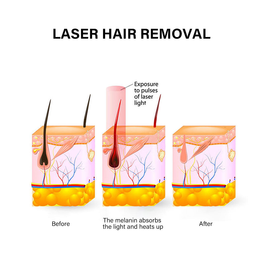 Диодный лазер для удаления волос Портативный лазер для депиляции 808 нм оборудование для парикмахерских эстетические машины для удаления волос с диодным лазером 