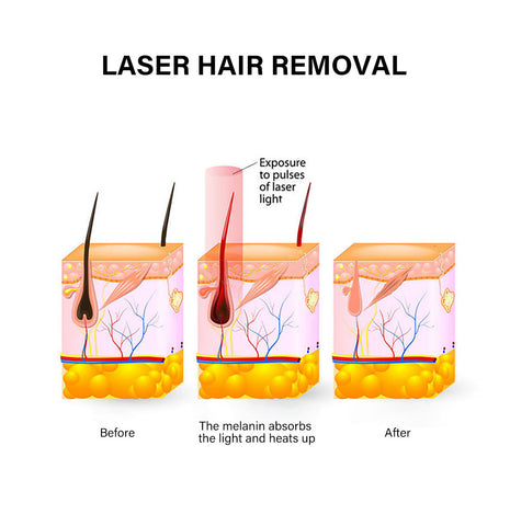 Diode Laser hair remove Portable depilacion laser 808nm hair salon equipment aesthetic diodo laser lazer hair removal machines