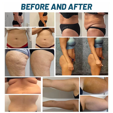 Before and after images of cryo slimming machine