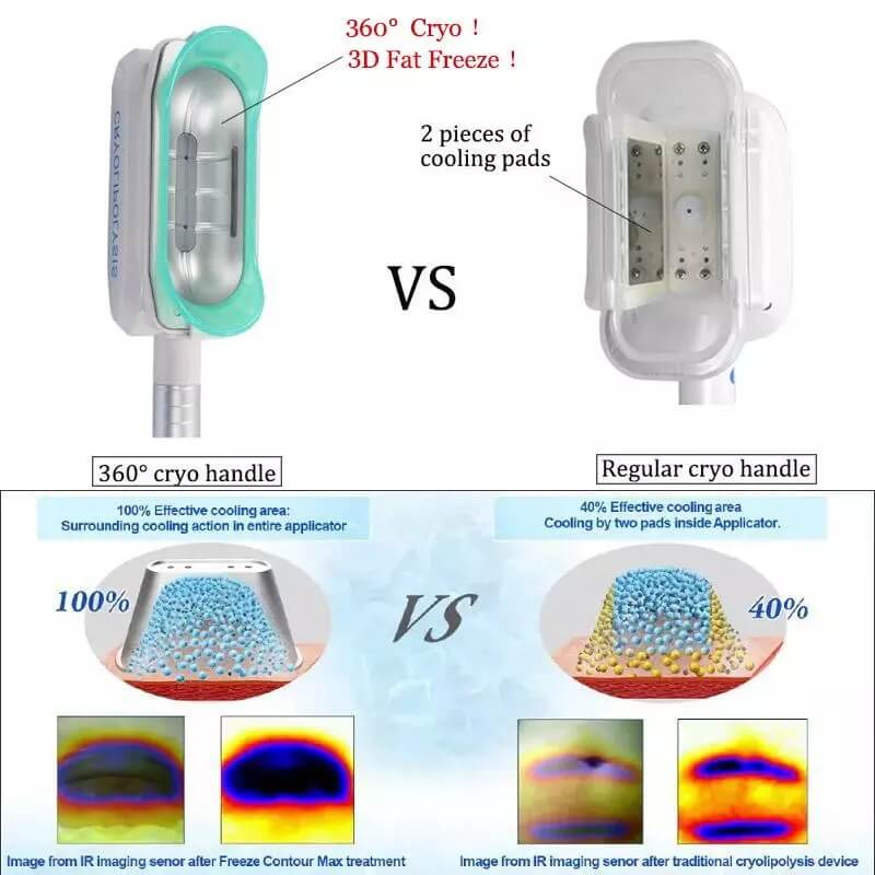 Mango de congelación de grasa Cryo 360 para LBT-M11